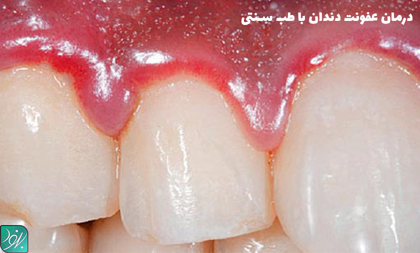 روش درمان عفونت دندان با طب سنتی
