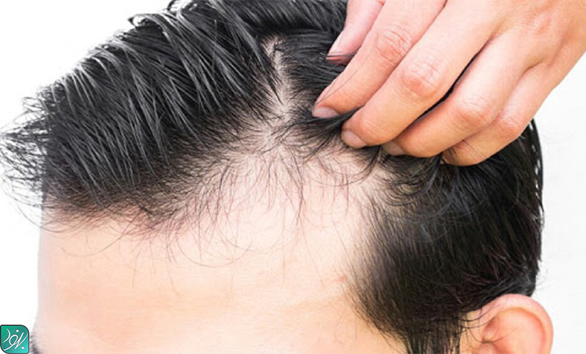 راهکار درمان ریزش مو با طب سنتی